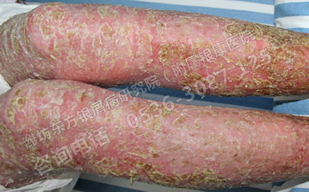 如何從銀屑病的病因上進行治療