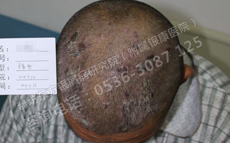 頭部牛皮屑怎么辦