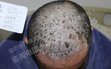 銀屑病幾個療程能好的?