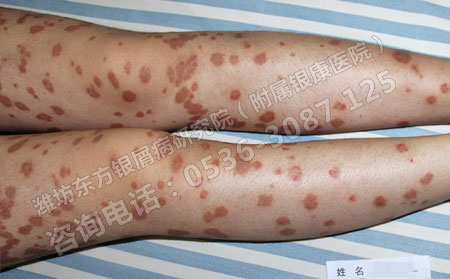 春季從哪些方面可以預防銀屑病復發(fā)