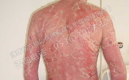 讓銀屑病能夠盡快治好的方法有哪些