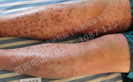 春季銀屑病患者皮膚干燥怎么辦