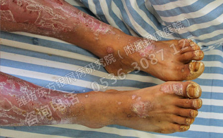 不同病情的銀屑病患者要如何進行治療