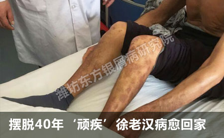 銀屑病愛心公益救治報道