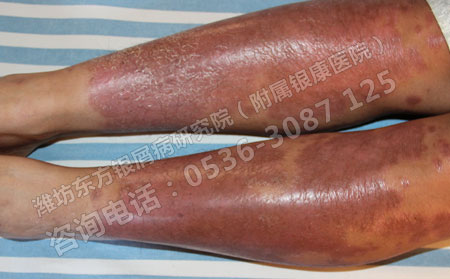 有效好的銀屑病濰坊銀屑病醫院能不能實現?