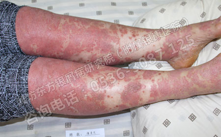 銀翹癬是牛皮癬嗎,怎么治療?
