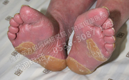 答疑解惑：怎樣治才能做到牛皮癬病情可以轉