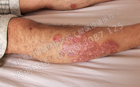 春季銀屑病復(fù)發(fā)嚴(yán)重如何治療