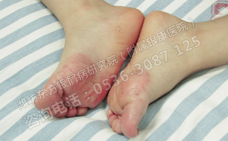 春季銀屑病該如何護理才能避免復發呢?