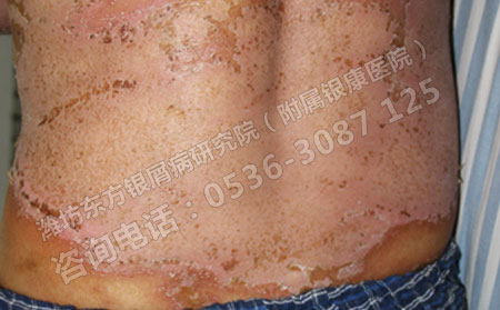 季節性銀屑病患者春季飲食注意事項