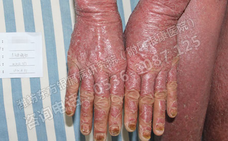 春季牛皮癬患者怎樣護(hù)理比較好