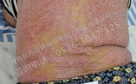 治銀屑病自身也很關鍵