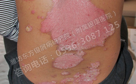 季節(jié)性銀屑病怎么預(yù)防護(hù)理遠(yuǎn)離疾病呢