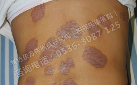 不同牛皮癬的治療方法不同