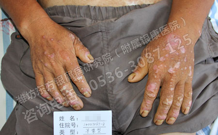 春季預防銀屑病有什么好的方法