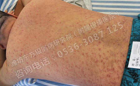 銀屑病的護理事項有哪些