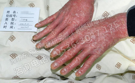 病情嚴(yán)重的銀屑病患者可以好的嗎？