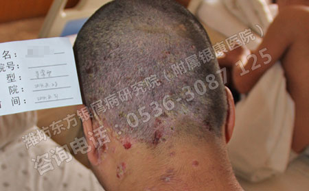 頭部牛皮屑怎么辦?哪里能好的