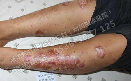 濰坊治療銀屑病什么醫院效果好