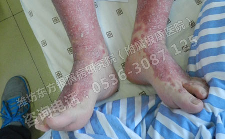 春季初發(fā)膿皰病銀屑病患者該怎么辦