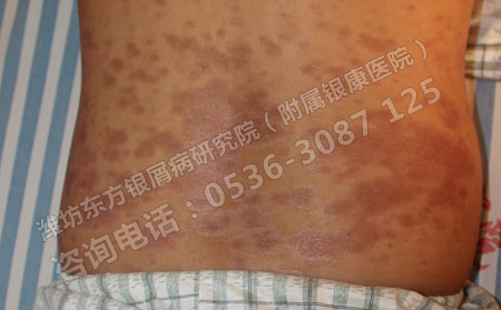 銀屑病要怎么治療才能達到理想的效果