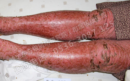 中醫(yī)治療銀屑病要幾個療程有效可以