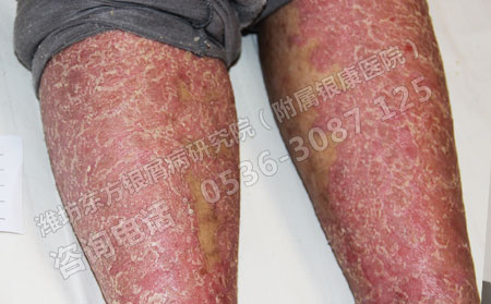 銀屑病春季反復嚴重該怎么治療