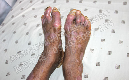 得了銀屑病關節(jié)部位卻總是不舒服怎么辦