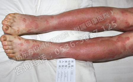 怎樣護(hù)理銀屑病患者的關(guān)節(jié)健康?