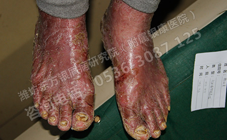 濰坊治療銀屑病有哪些好的方法