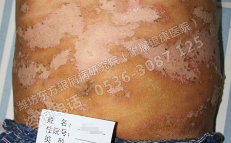 銀屑病患者的日常飲食很重要嗎