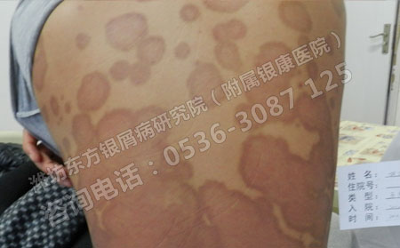 皮膚上一點點銀屑病紅斑怎么治快速消退呢