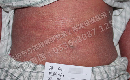 治療頑固性銀屑病有辦法縮短治療療程嗎