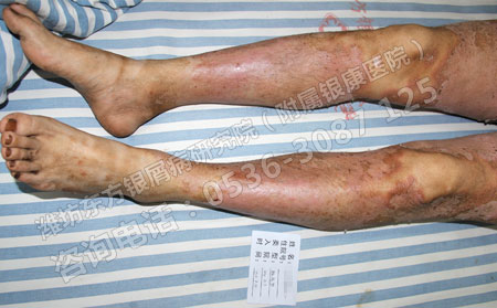 一般的銀屑病治療時(shí)間是多少固不固定呢