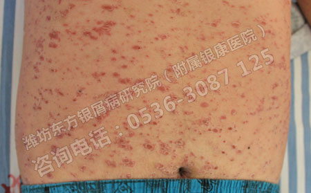 牛皮癬在治療時要避免進入哪些誤區