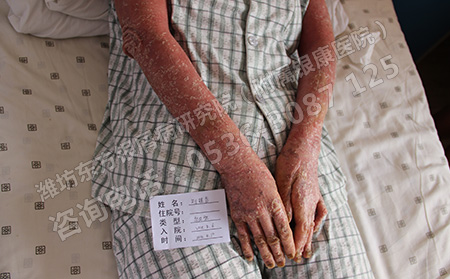 銀屑病患者的飲食要注意哪些方面