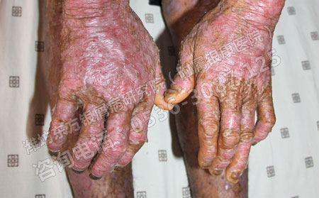 關節型銀屑病在生活中需要注意哪些問題