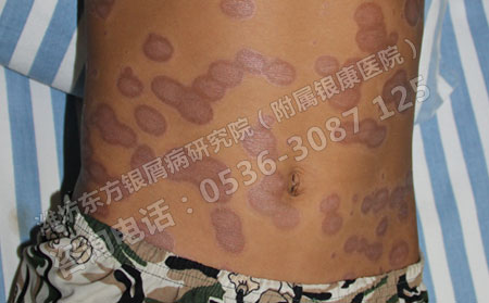 不同銀屑病要注意分型分期對癥治療