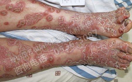 銀屑病性關(guān)節(jié)炎 調(diào)養(yǎng)有度效果好