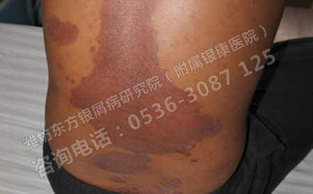 牛皮癬要怎么治療能減少治療費用