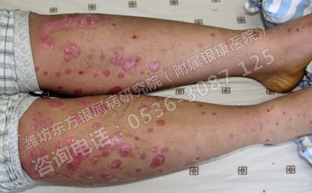 復發型銀屑病怎么治療好如何減少復發有妙招