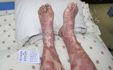 濰坊規范治療銀屑病的可以醫院