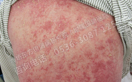 銀屑病需要住院治療嗎