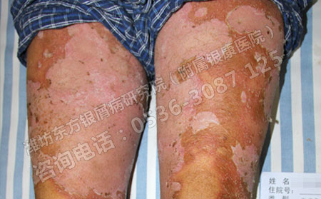 如何有效預防銀屑病的復發