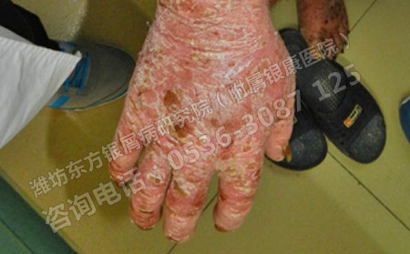 怎樣預防膿皰型銀屑病危害患者的身心健康