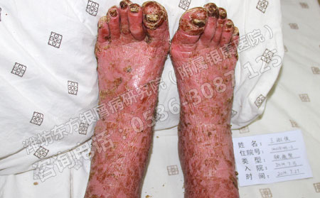 濰坊東方醫院治療十幾年的銀屑病要幾個療程