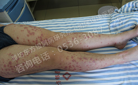 銀屑病反復發作要如何治療呢