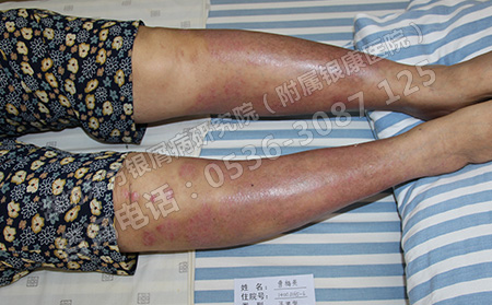 一些有利于銀屑病的治好的危險小療法介紹