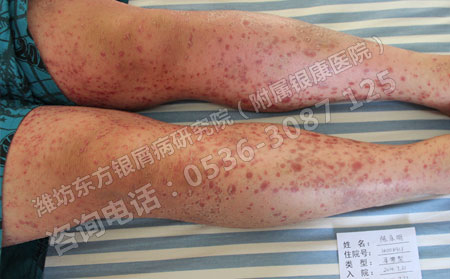 得了銀屑病，患者要怎樣科學(xué)對(duì)待?