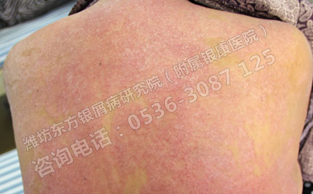 在濰坊大概要花多少錢才能將銀屑病來好的